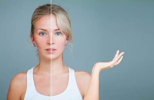 Young Woman with hand raised. Unhealthy and Healthy Skin After Treatment. Facial Treatment, Medicine and Cosmetology Concept. Perfect Skin and Skin Problem.